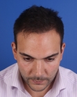 After Hair Transplant&nbsp;Front
